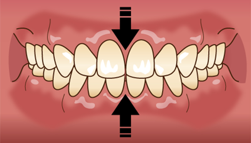 歯の噛みしめ：クレンチングの症状は？