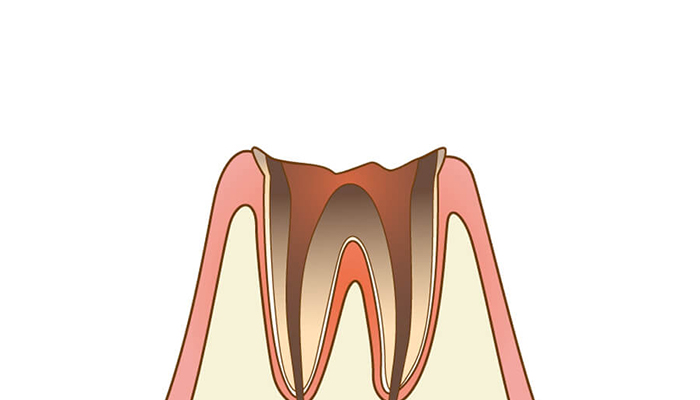 C4：歯冠部（歯の見える部分）がほとんどなくなり、歯の根だけ残った状態